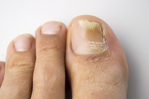 fungal nail infection pedicure amsterdam